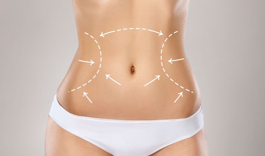 Why a Tummy Tuck is Still the Best Choice for That Unwanted Belly